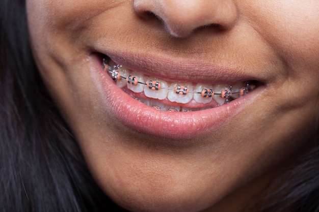 Mujer sonriendo con aparato de dientes