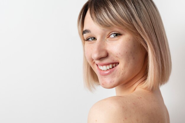 Mujer sonriente con acné posando