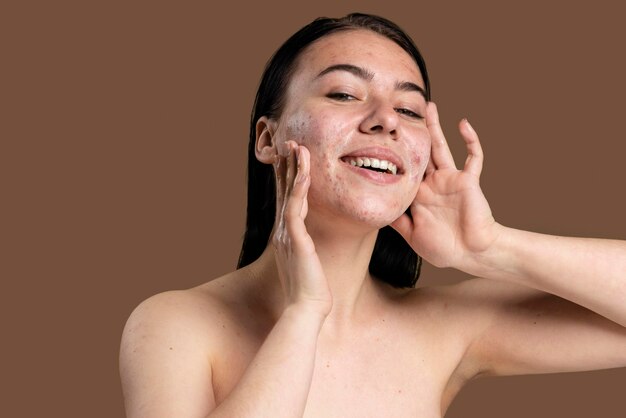 Mujer sonriente mostrando su acné con confianza