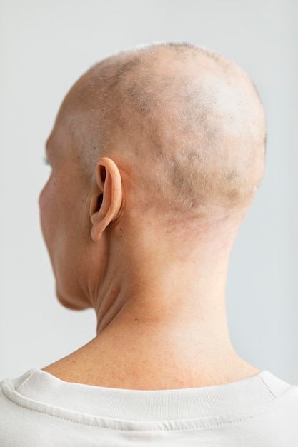Mujer de vista posterior con cáncer de piel