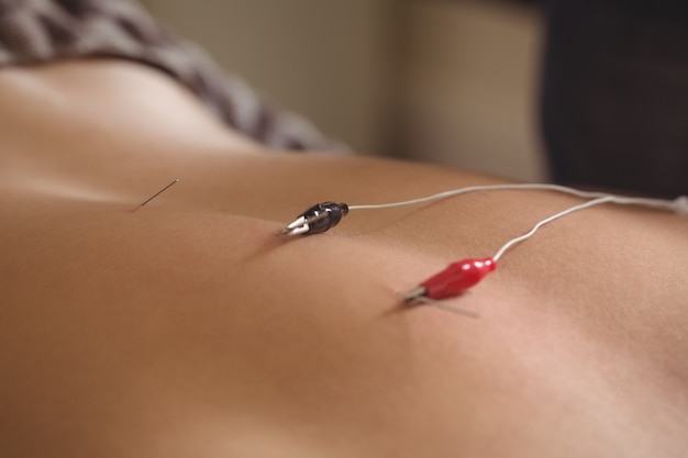 Paciente con punción electro seca en la espalda