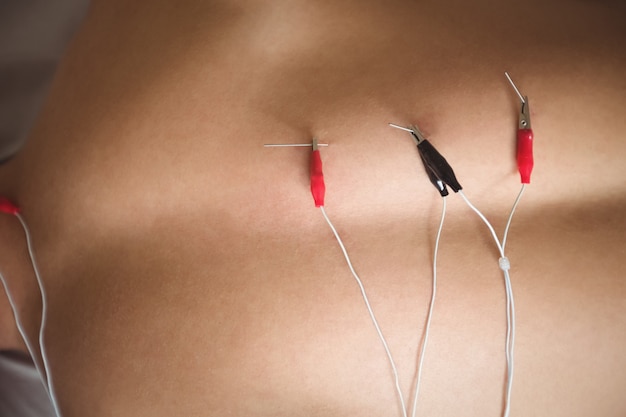 Foto gratuita paciente con punción electro seca en la espalda