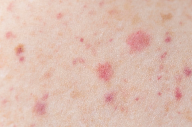 Foto gratuita persona que tiene un primer plano de alergia en la piel