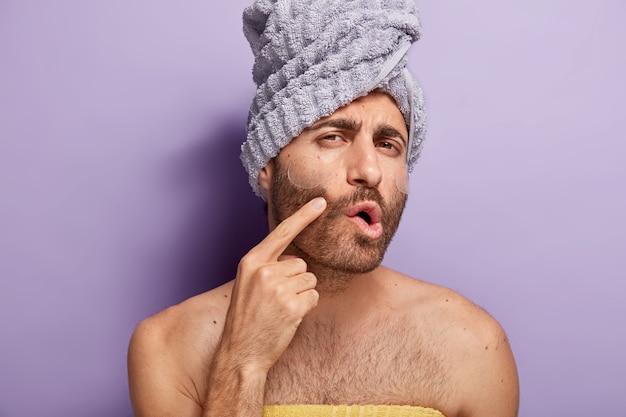 Primer plano de un hombre caucásico serio que apunta a la mejilla, muestra piel problemática, tiene barba, se aplica parches de silicona debajo de los ojos, se para los hombros desnudos, tiene una toalla envuelta en la cabeza. Concepto de mimos