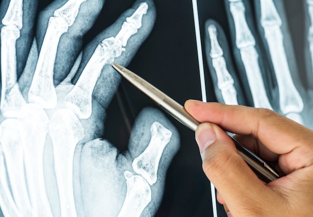 Primer plano de la película de rayos X de un dedo fracturado