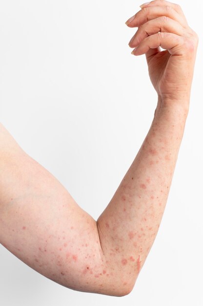 Prueba de reacción alérgica cutánea en el brazo de una persona