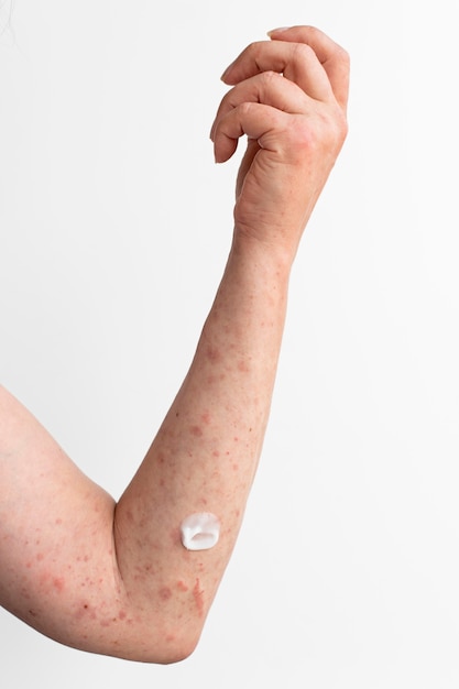 Foto gratuita prueba de reacción alérgica cutánea en el brazo de una persona