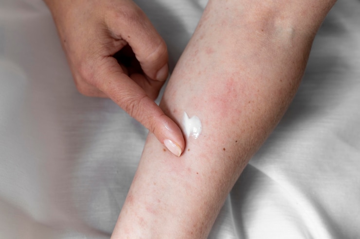 Foto gratuito prueba de reacción alérgica cutánea en el brazo