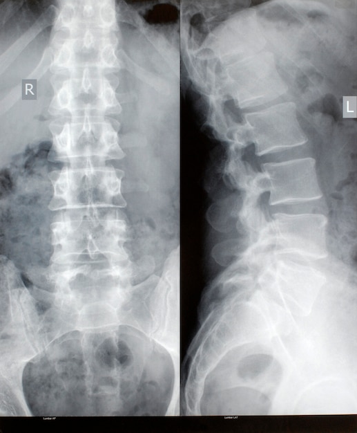 Foto gratuita radiografía de la espina dorsal