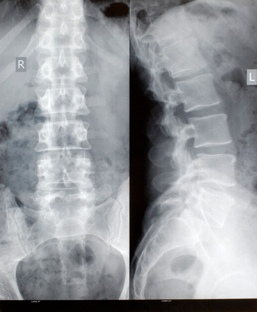 Radiografía de la espina dorsal