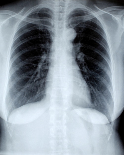Radiografía del pecho de una mujer