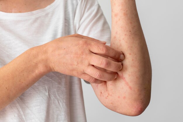 Reacción alérgica cutánea en el brazo de la persona.