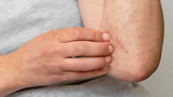 Foto gratuita reacción alérgica cutánea en el brazo de la persona.