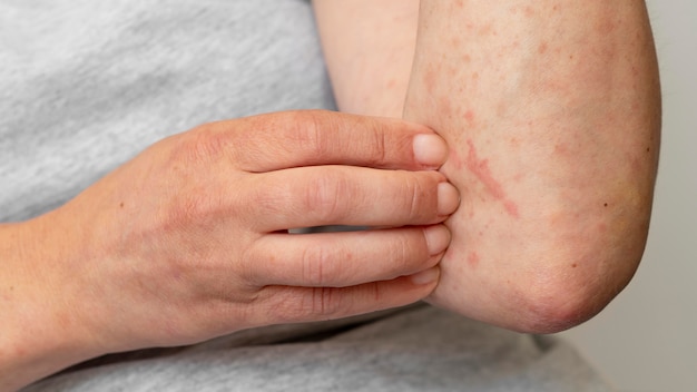 Reacción alérgica cutánea en el brazo de la persona.