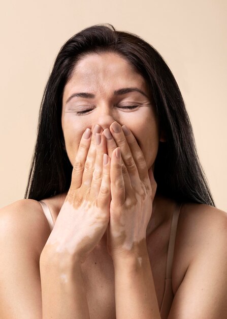 Retrato de mujer hermosa con vitiligo