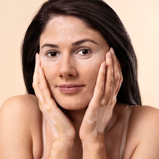 Retrato de mujer hermosa con vitiligo