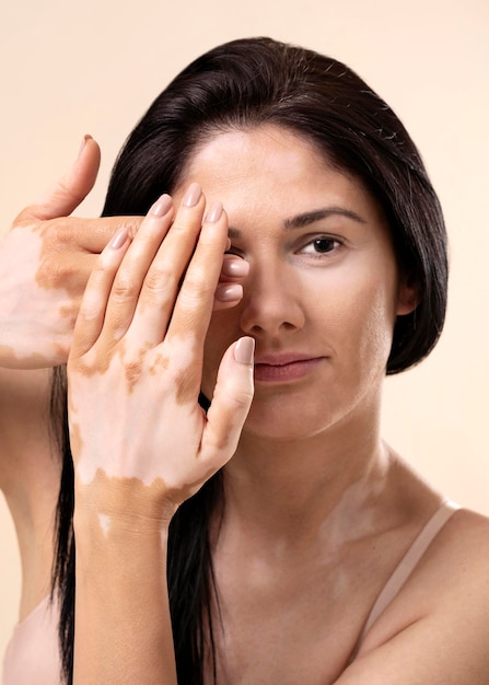 Retrato de mujer hermosa con vitiligo