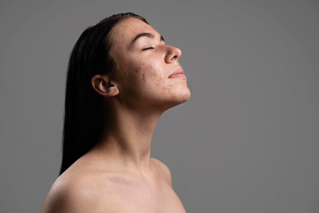 Retrato de mujer joven confiada con acné