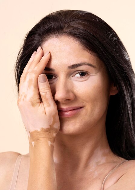 Retrato de mujer segura de sí misma con vitiligo