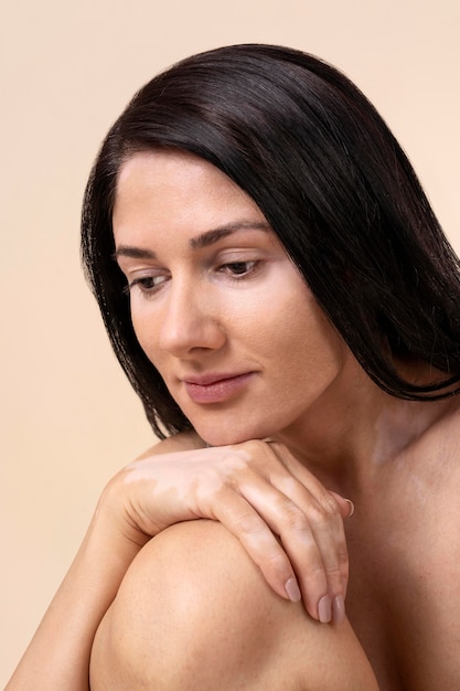 Retrato de mujer segura de sí misma con vitiligo