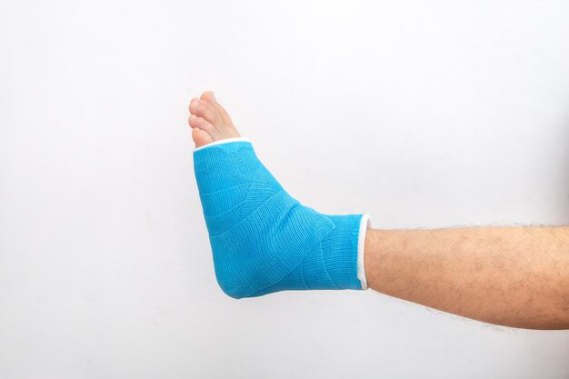 Tobillo entablillado azul. Yeso de pierna vendada en paciente masculino sobre fondo blanco aislado. Concepto de lesiones deportivas.