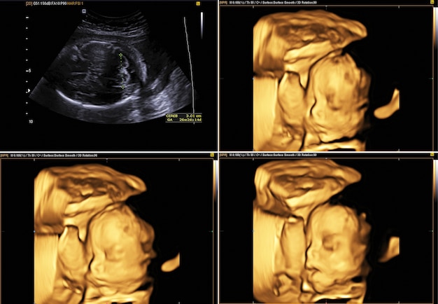 Ultrasonido Del Bebe En El Utero De La Madre Imagen Ultrasonido 3d 4d Del Bebe En El Utero De La Madre Foto Premium Ultrasonido Del Bebe En El Utero De La Madre Imagen Ultrasonido 3d 4d Del Bebe En El Utero De La Madre Foto Premium