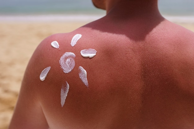 Foto gratuita vista del hombre aplicando loción en la piel quemada por el sol en la playa