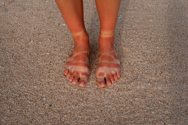 Vista de los pies quemados por el sol de una mujer por usar sandalias en la playa