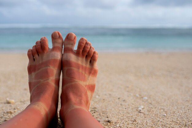 Vista de los pies quemados por el sol de una mujer por usar sandalias en la playa