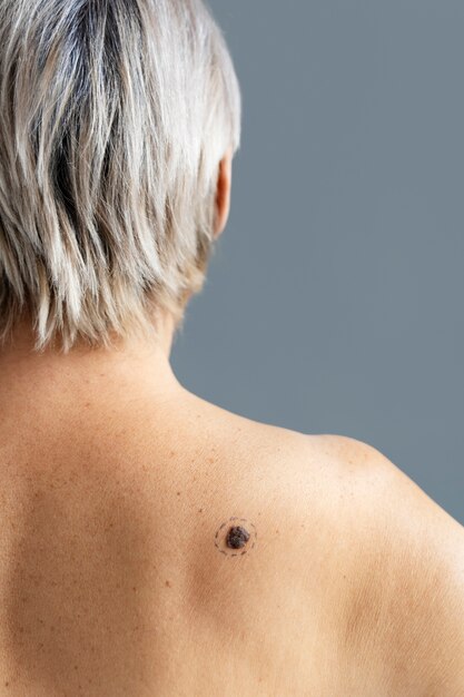 Vista trasera mujer con melanoma