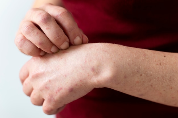 Allergia cutanea sul braccio di una persona