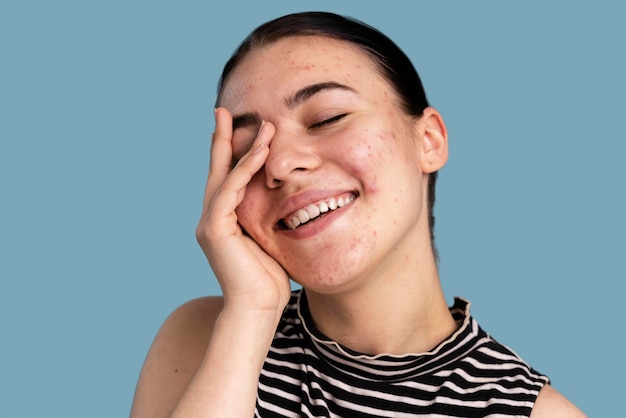Bella giovane donna con l'acne