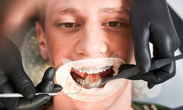 Dentista che esamina i denti dell'uomo con esploratore dentale e specchio dentale
