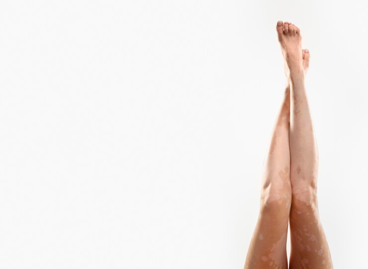 Foto gratuito giovane donna con gambe vitiligine