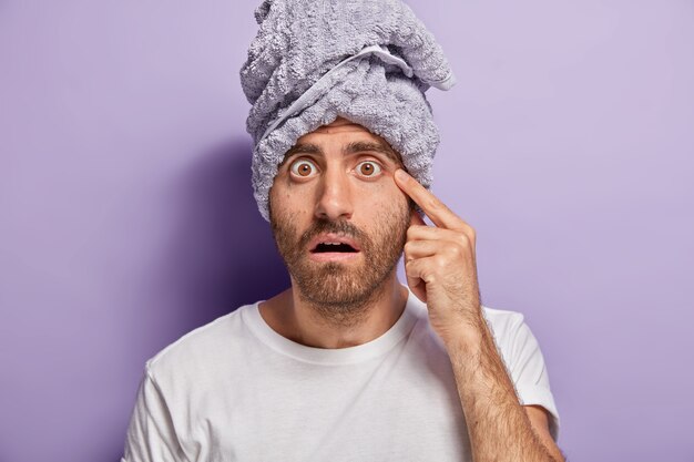 L'uomo scioccato nota l'acne sul viso, ha gli occhi spalancati, setola, si prende cura della pelle, indossa un asciugamano avvolto, maglietta casual