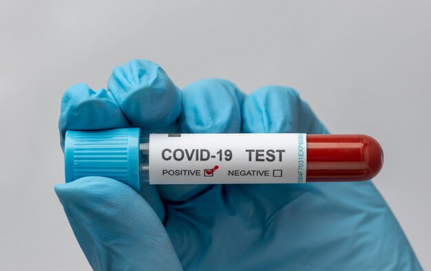 Mano con guanti protettivi in possesso di un campione di sangue per il test covid