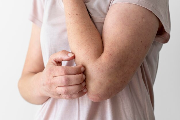 Reazione allergica cutanea sul braccio della persona