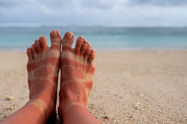 Vista dei piedi delle scottature solari di una donna indossando sandali in spiaggia