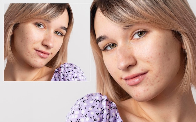 Vista frontale donna con problemi di acne