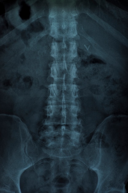X raggio di una colonna vertebrale