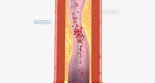 A narrowed carotid artery can cause reduced blood flow to the brain