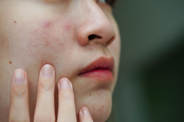 Acne brufolo e cicatrice sulla pelle viso disturbi delle ghiandole sebacee problema di bellezza per la cura della pelle di una ragazza adolescente