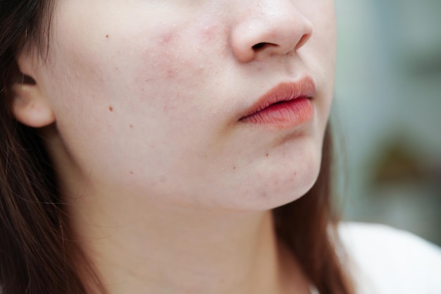 Acne brufolo e cicatrice sulla pelle viso disturbi delle ghiandole sebacee problema di bellezza per la cura della pelle di una ragazza adolescente