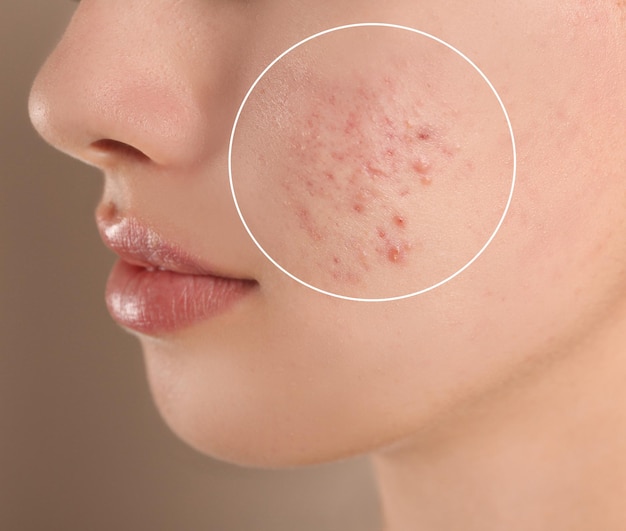 Adolescente con problemi di acne su sfondo beige primo piano