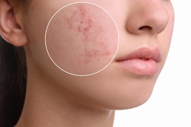 Adolescente con problemi di acne su sfondo bianco primo piano