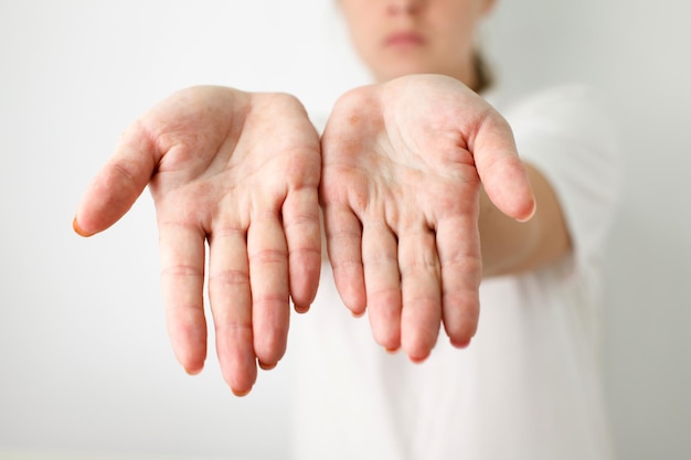 Affrontare le allergie Primo piano delle mani rosse e irritate di una donna