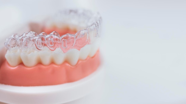 Aligners invisibili e rimovibili per l'allineamento dei denti