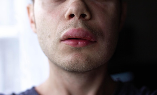 angioedema. Reazione allergica al labbro. Orticaria