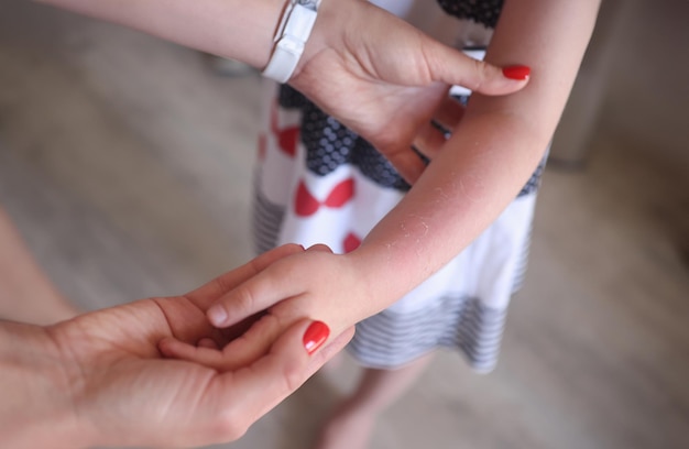 Arrossamento della scottatura solare e desquamazione della pelle sul primo piano della mano del bambino