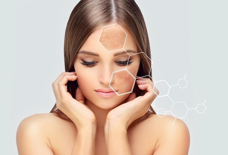 Photo bintik hitam, bintik-bintik, hiperpigmentasi, melasma, atau konsep kloasma pemutih kulit